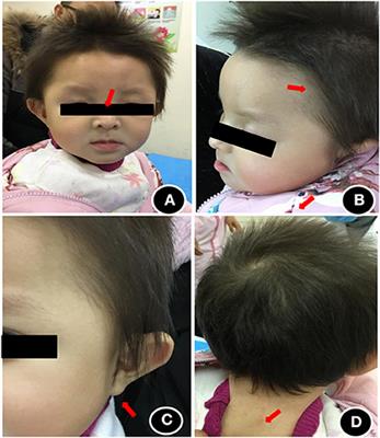 Case report: Identification and clinical phenotypic analysis of novel mutation of the PPP1CB gene in NSLH2 syndrome